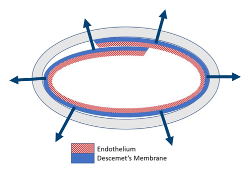 DMEK-EndoGlide-scroll