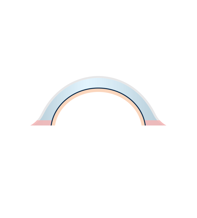 Keratolimbal allograft icon